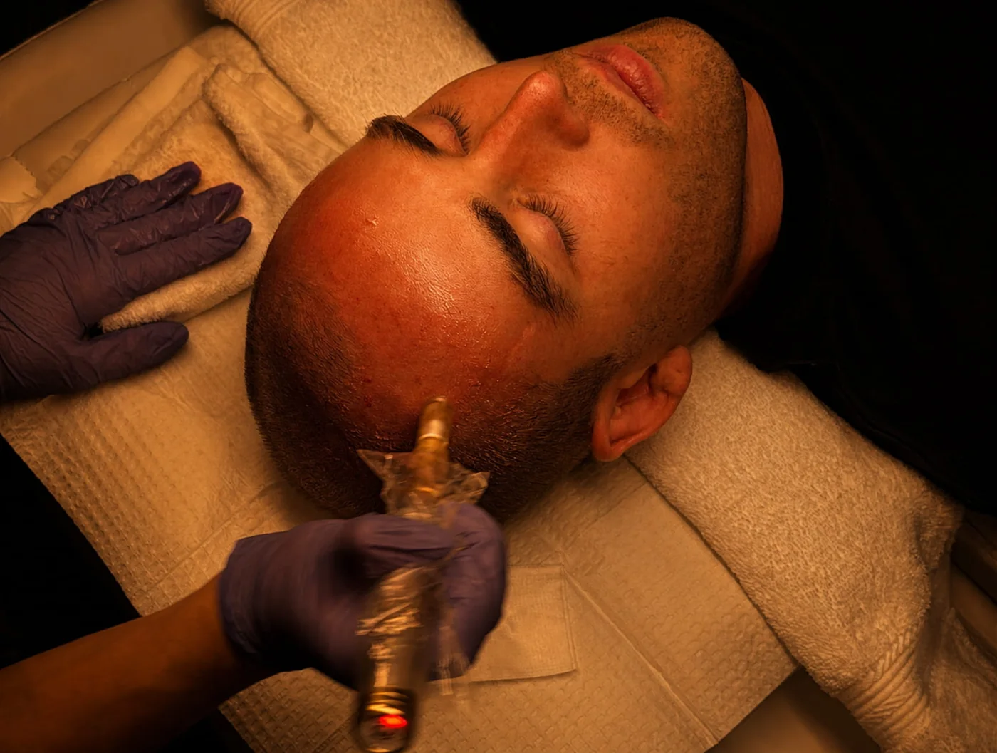 A scalp treatment in progress at the Costa Mesa clinic.